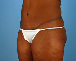 Tummy Tuck Before and After | Dr. Thomas Hubbard