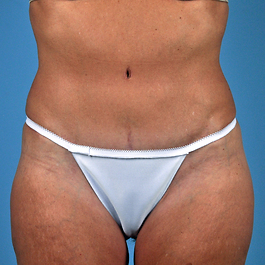 Tummy Tuck Before and After | Dr. Thomas Hubbard