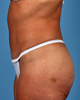 Tummy Tuck Before and After | Dr. Thomas Hubbard