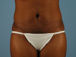 Tummy Tuck Before and After | Dr. Thomas Hubbard