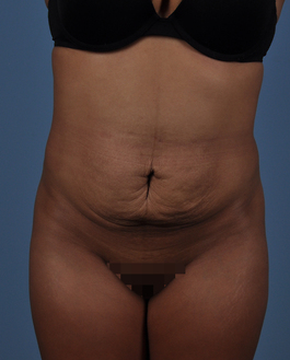 Tummy Tuck Before and After | Dr. Thomas Hubbard