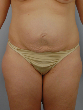 Tummy Tuck Before and After | Dr. Thomas Hubbard