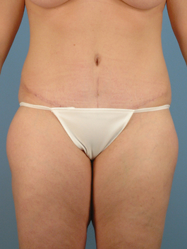 Tummy Tuck Before and After | Dr. Thomas Hubbard