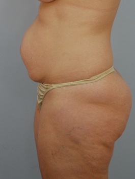 Tummy Tuck Before and After | Dr. Thomas Hubbard