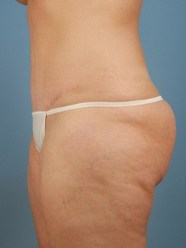 Tummy Tuck Before and After | Dr. Thomas Hubbard