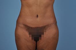 Tummy Tuck Before and After | Dr. Thomas Hubbard