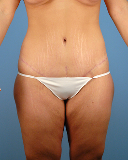 Tummy Tuck Before and After | Dr. Thomas Hubbard