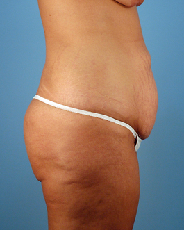 Tummy Tuck Before and After | Dr. Thomas Hubbard