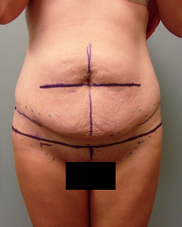 Tummy Tuck Before and After | Dr. Thomas Hubbard