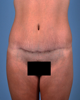 Tummy Tuck Before and After | Dr. Thomas Hubbard