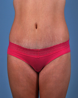 Tummy Tuck Before and After | Dr. Thomas Hubbard