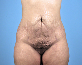 Tummy Tuck Before and After | Dr. Thomas Hubbard