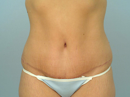 Tummy Tuck Before and After | Dr. Thomas Hubbard