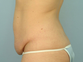 Tummy Tuck Before and After | Dr. Thomas Hubbard