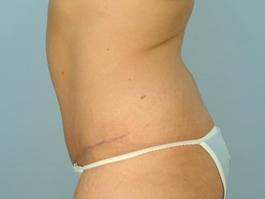 Tummy Tuck Before and After | Dr. Thomas Hubbard