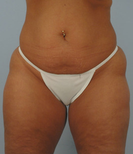 Tummy Tuck Before and After | Dr. Thomas Hubbard