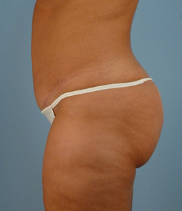 Tummy Tuck Before and After | Dr. Thomas Hubbard