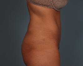 Tummy Tuck Before and After | Dr. Thomas Hubbard