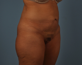 Tummy Tuck Before and After | Dr. Thomas Hubbard