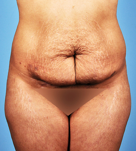 Tummy Tuck Before and After | Dr. Thomas Hubbard