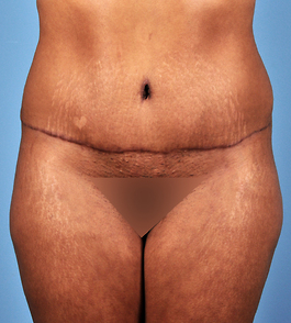 Tummy Tuck Before and After | Dr. Thomas Hubbard