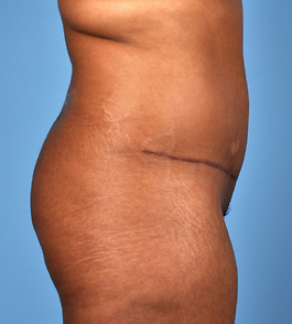 Tummy Tuck Before and After | Dr. Thomas Hubbard