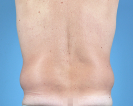 Tummy Tuck Before and After | Dr. Thomas Hubbard