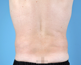 Tummy Tuck Before and After | Dr. Thomas Hubbard