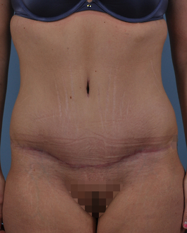 Tummy Tuck Before and After | Dr. Thomas Hubbard