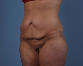 Tummy Tuck Before and After | Dr. Thomas Hubbard