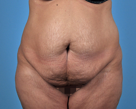 Tummy Tuck Before and After | Dr. Thomas Hubbard