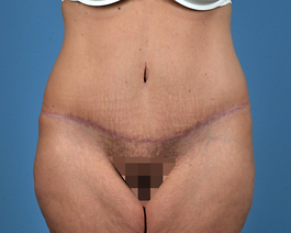 Tummy Tuck Before and After | Dr. Thomas Hubbard