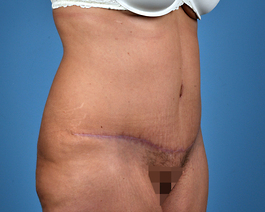 Tummy Tuck Before and After | Dr. Thomas Hubbard