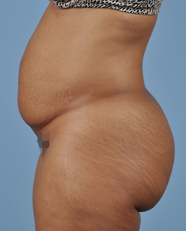 Tummy Tuck Before and After | Dr. Thomas Hubbard