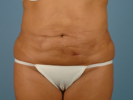 Tummy Tuck Before and After | Dr. Thomas Hubbard