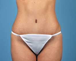 Tummy Tuck Before and After | Dr. Thomas Hubbard