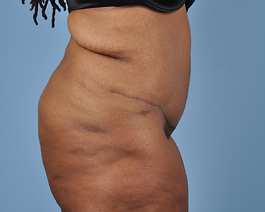 Tummy Tuck Before and After | Dr. Thomas Hubbard