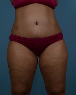 Tummy Tuck Before and After | Dr. Thomas Hubbard