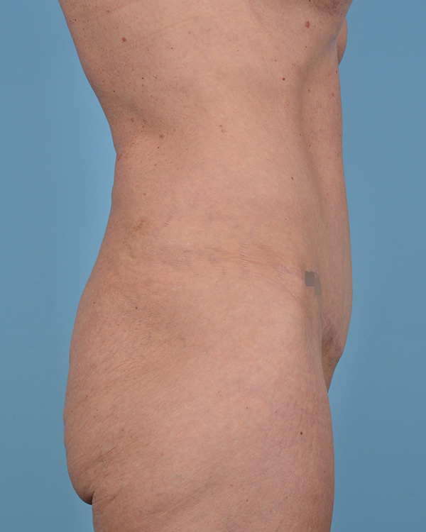 Tummy Tuck Before and After | Dr. Thomas Hubbard