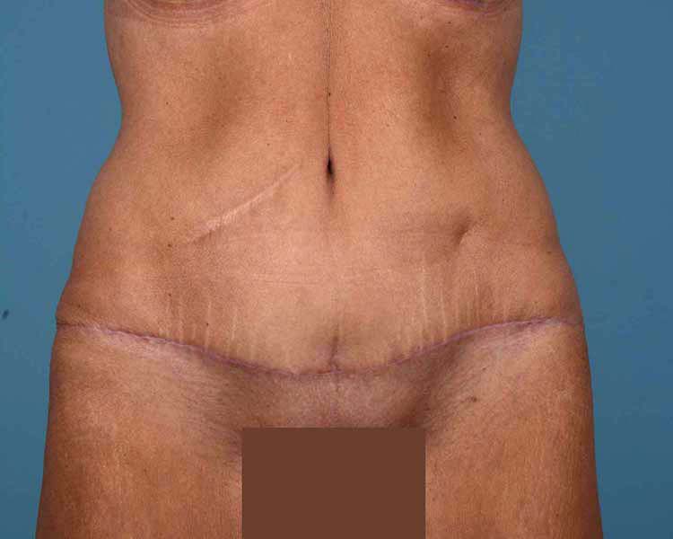 Tummy Tuck Before and After | Dr. Thomas Hubbard