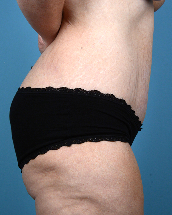 Tummy Tuck Before and After | Dr. Thomas Hubbard