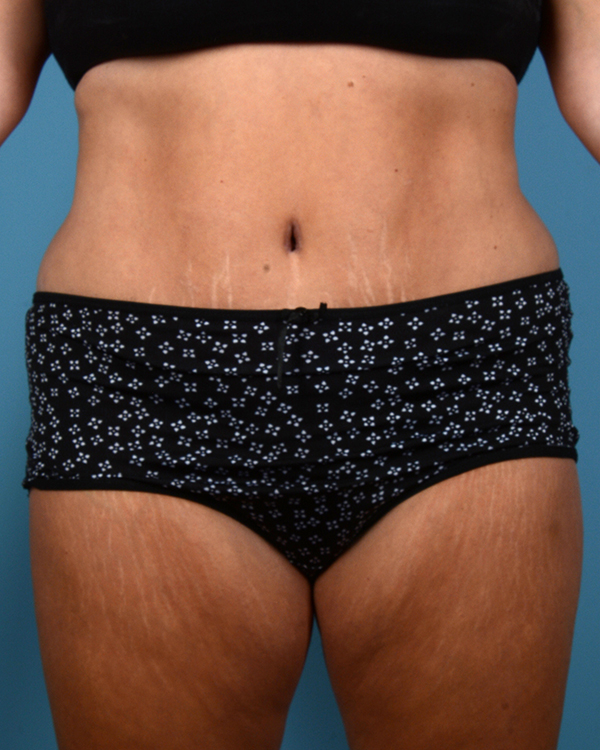 Tummy Tuck Before and After | Dr. Thomas Hubbard