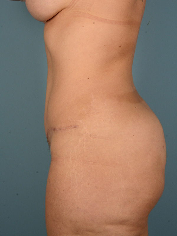 Tummy Tuck Before and After | Dr. Thomas Hubbard