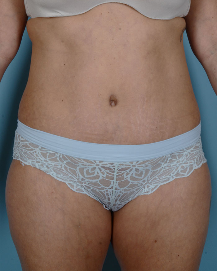 Tummy Tuck Before and After | Dr. Thomas Hubbard