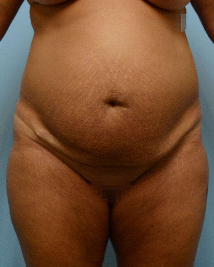 Tummy Tuck Before and After | Dr. Thomas Hubbard