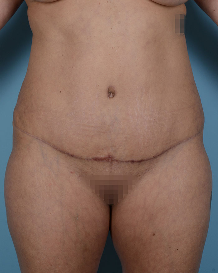 Tummy Tuck Before and After | Dr. Thomas Hubbard