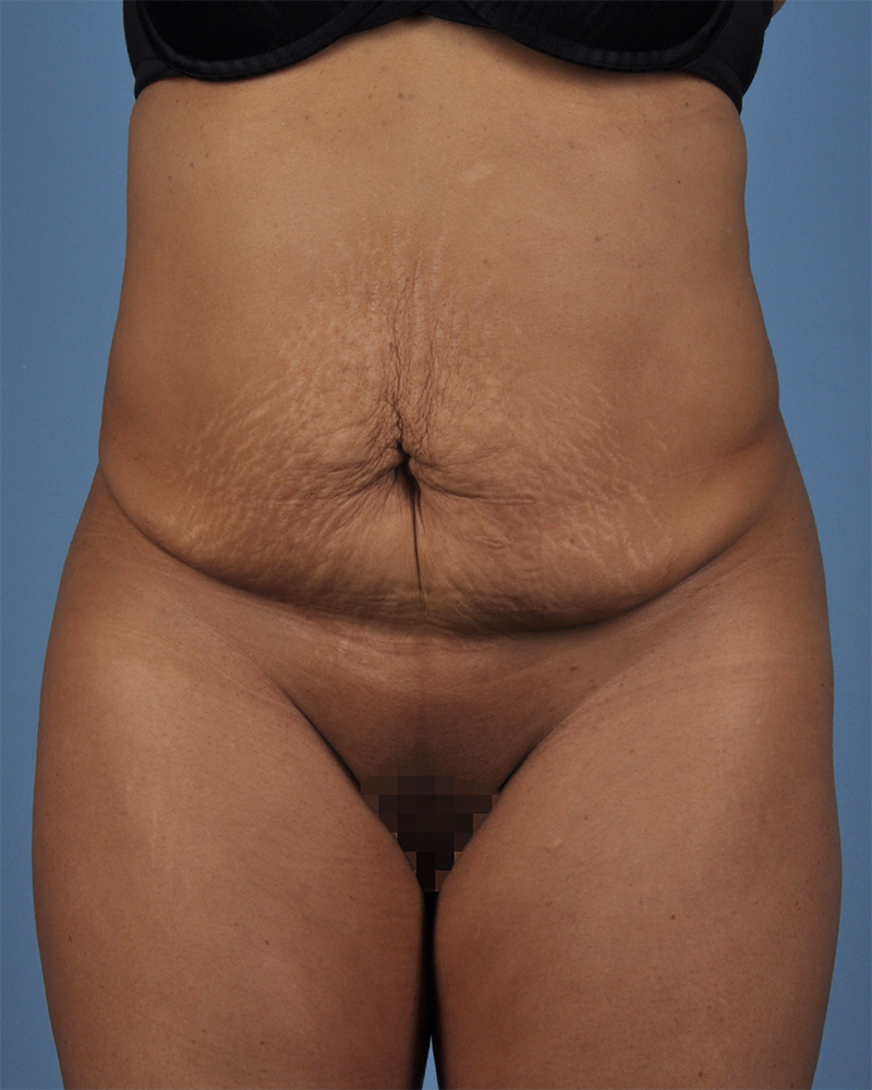 Tummy Tuck Before and After | Dr. Thomas Hubbard