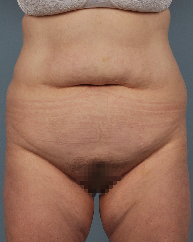 Tummy Tuck Before and After | Dr. Thomas Hubbard