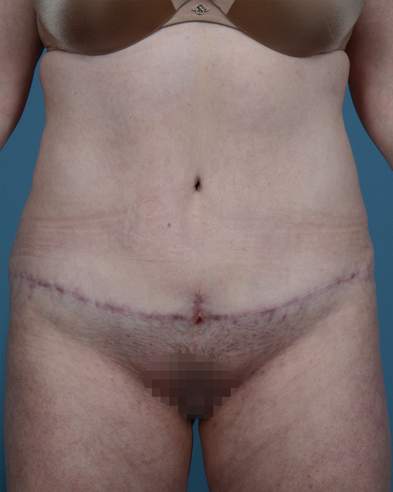 Tummy Tuck Before and After | Dr. Thomas Hubbard