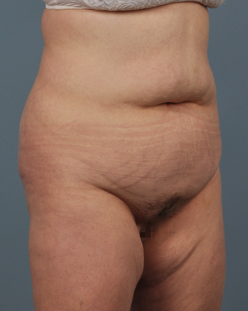 Tummy Tuck Before and After | Dr. Thomas Hubbard